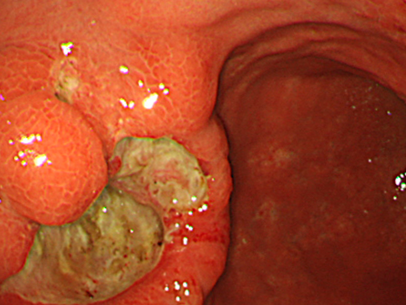 胃潰瘍